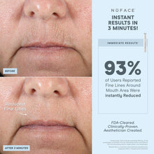 Load image into Gallery viewer, NuFACE - FIX® Line Smoothing Device