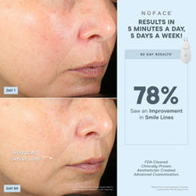 Load image into Gallery viewer, NuFACE - TRINITY+ PRO Effective Lip &amp; Eye Attachment
